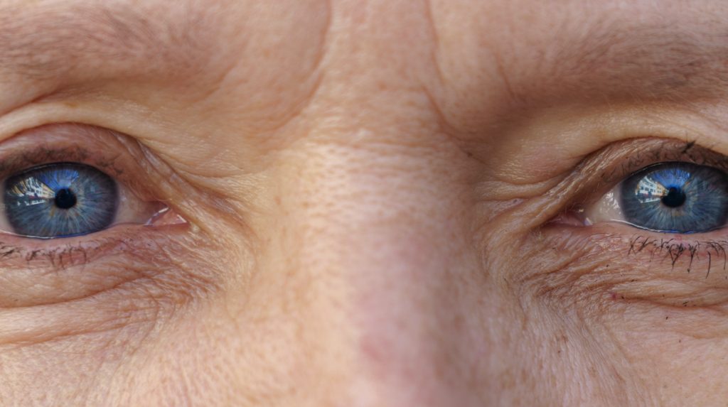 eyelid-ptosis-repair-palm-beach-gardens-jupiter-fl-ooc